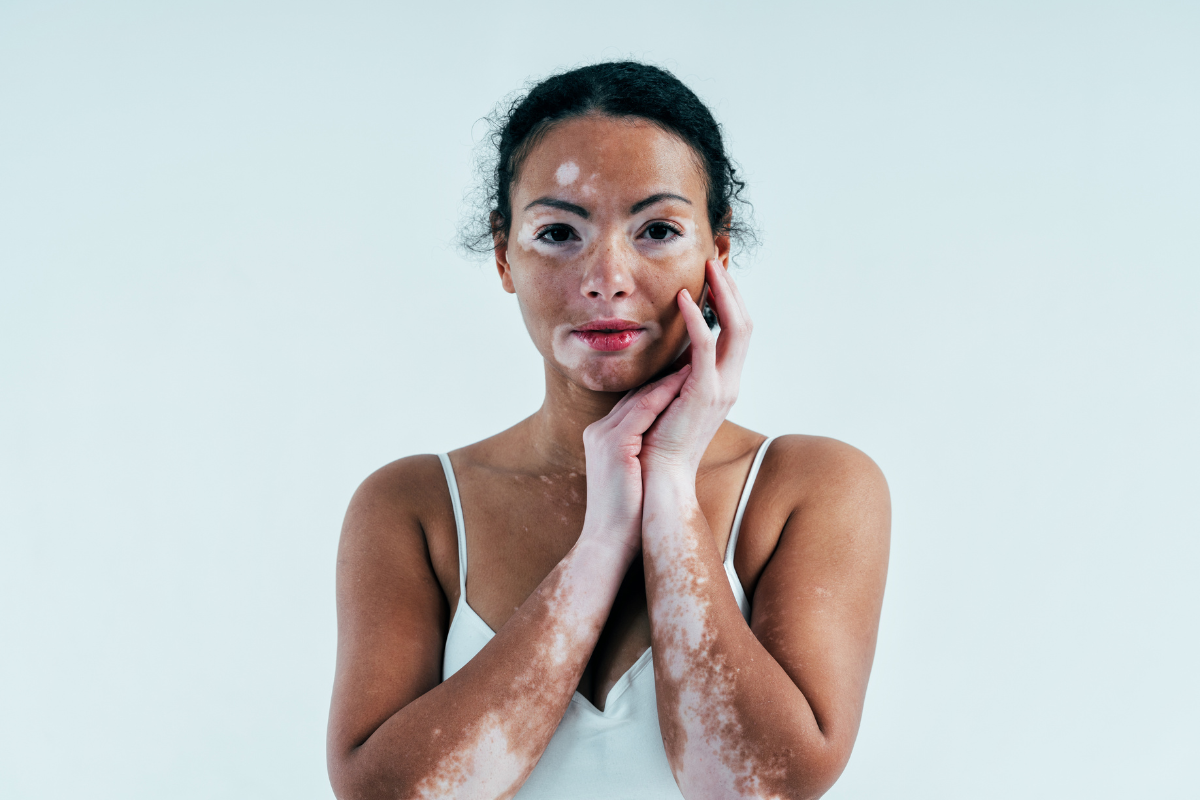 Kollagen vid vitiligo collagen celloptimum