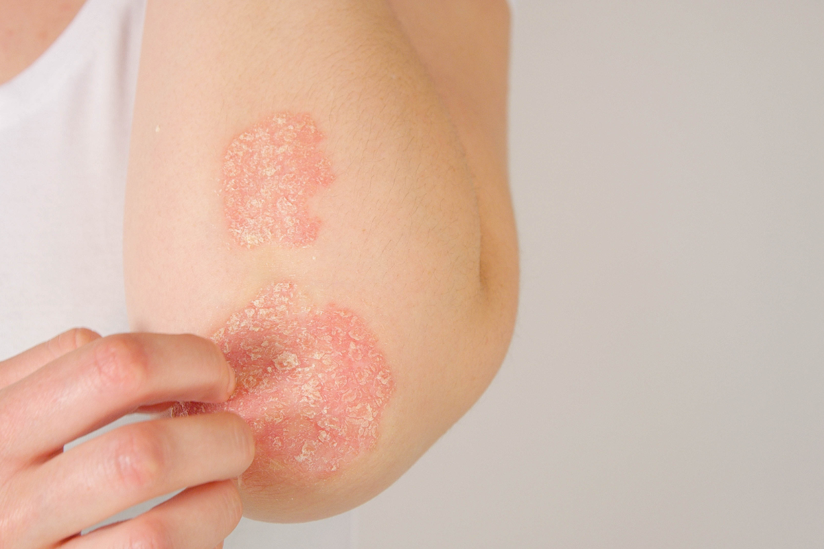 eczema psoriasis collagen kollagen psoriasis eksem celloptimum kosttillskott